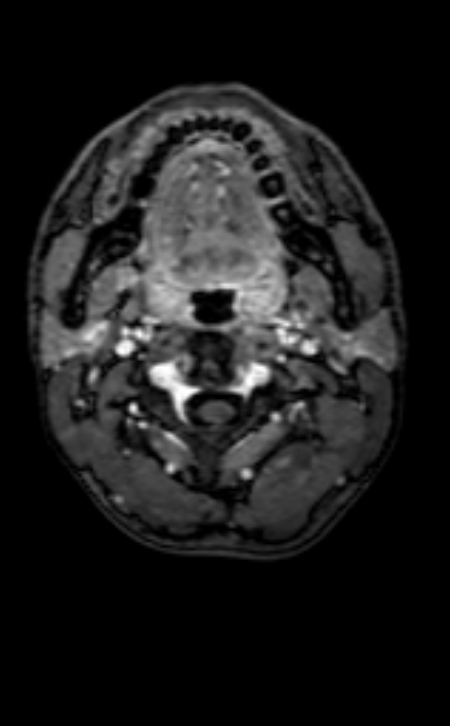 Neuro-Behçet disease (Radiopaedia 90112-107294 Axial T1 C+ 232).jpg