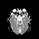File:Neuro-Behcet's disease (Radiopaedia 21557-21505 Axial ADC 8).jpg
