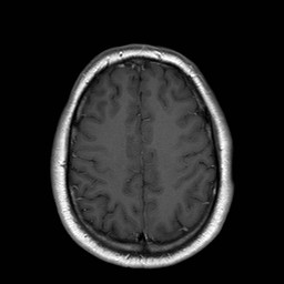 File:Neuro-Behcet's disease (Radiopaedia 21557-21505 Axial T1 C+ 17).jpg