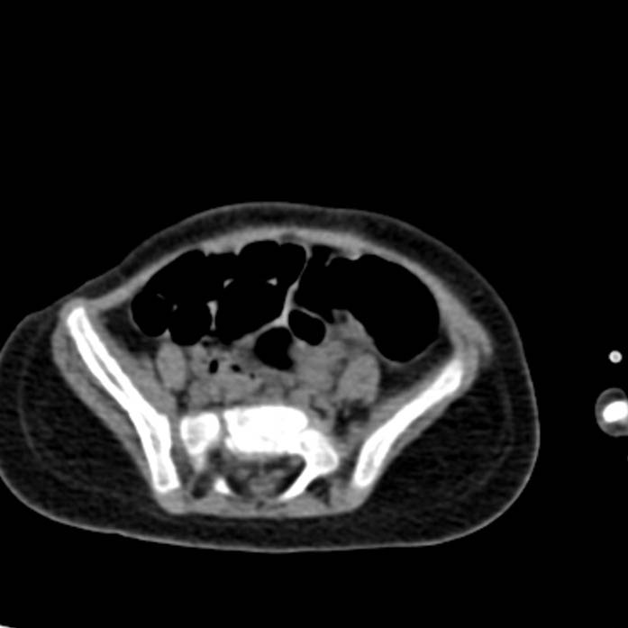 Neuroblastoma with skull metastases (Radiopaedia 30326-30960 Axial non-contrast 46).jpg