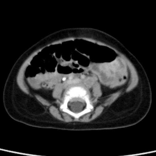 Neuroblastoma with skull metastases (Radiopaedia 30326-30960 C 40).jpg