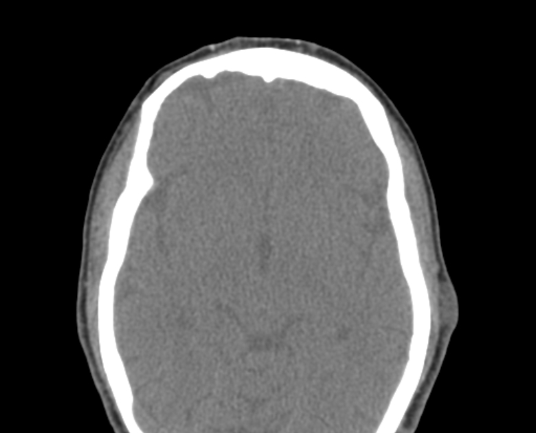 Neurofibromatosis type 1- orbital manifestations (Radiopaedia 49391-54511 Axial non-contrast 72).jpg