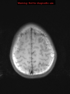 File:Neurofibromatosis type 1 with optic nerve glioma (Radiopaedia 16288-15965 Axial T1 4).jpg