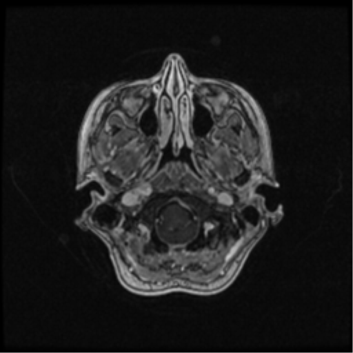 Neurofibromatosis type 2 (Radiopaedia 45229-49244 Axial T1 C+ 28).png