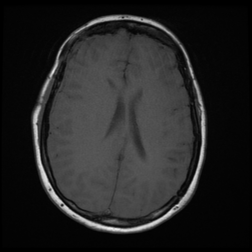 File:Neurofibromatosis type 2 (Radiopaedia 45229-49247 Axial T1 14).png