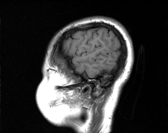 File:Neurofibromatosis type 2 (Radiopaedia 66211-75401 Sagittal T1 3).jpg