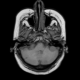 File:Neurofibromatosis type 2 (Radiopaedia 8713-9518 Axial T1 20).jpg