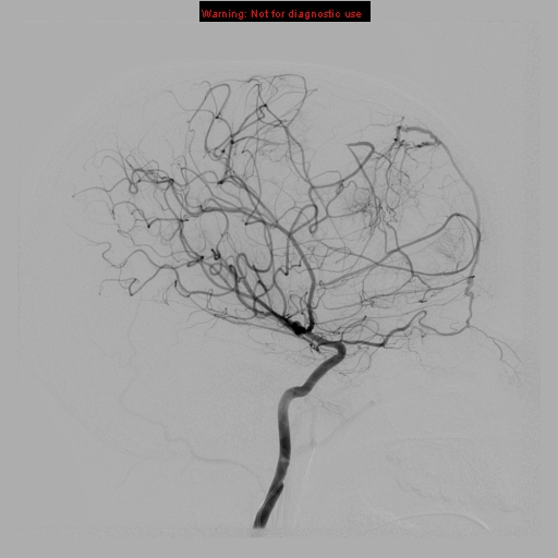 File:Neurofibromatosis type 2 (Radiopaedia 8953-9733 B 4).jpg