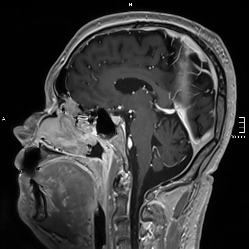 Neurosarcoidosis - involvement of the mesial temporal lobes (Radiopaedia 67429-76820 Sagittal T1 C+ 91).jpg