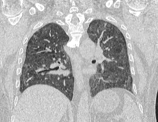 Non specific interstitial pneumonia (NSIP) (Radiopaedia 89725-106798 Coronal lung window 47).jpg