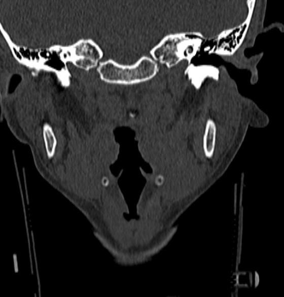 File:Normal CT cervical spine - 12-year-old (Radiopaedia 55352-61775 Coronal bone window 14).jpg
