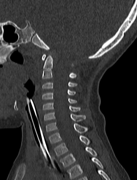 Normal CT cervical spine - pediatric (Radiopaedia 52549-58462 Sagittal bone window 108).jpg