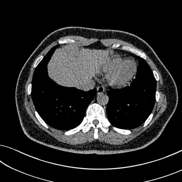 Normal CT chest- adult female (Radiopaedia 52522-58428 Axial non-contrast 99).jpg