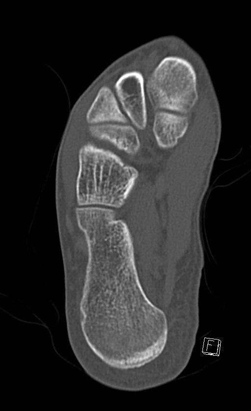 Normal CT of the ankle (Radiopaedia 47111-51658 Axial bone window 78).jpg