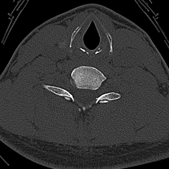 Normal CT of the cervical spine (Radiopaedia 53322-59305 Axial bone window 192).jpg