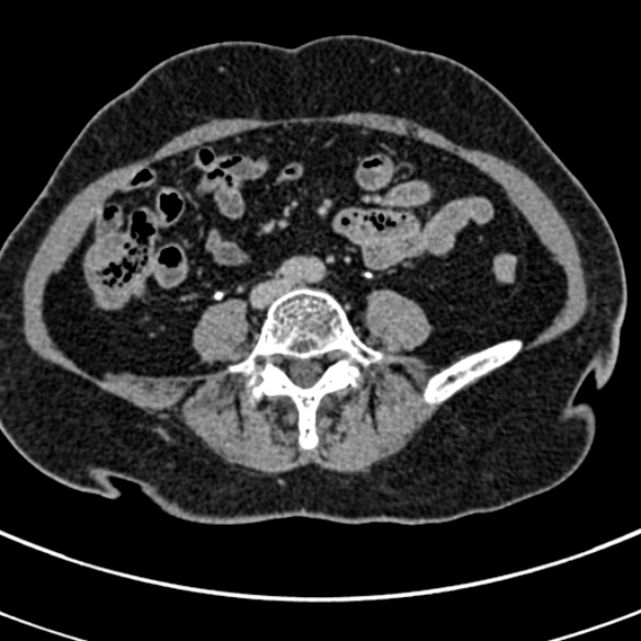 File:Normal CT split bolus study of the renal tract (Radiopaedia 48631-53634 Axial split bolus 167).jpg