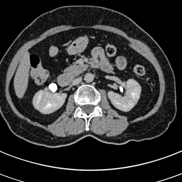 File:Normal CT split bolus study of the renal tract (Radiopaedia 48631-53634 Axial split bolus 80).jpg