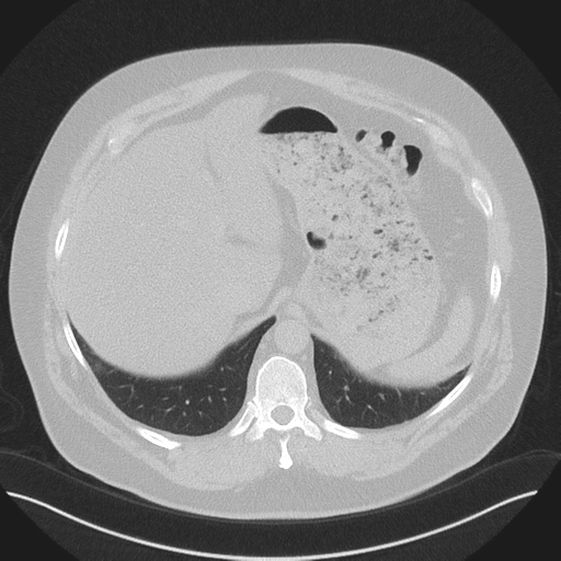 Normal HRCT (Radiopaedia 40797-43458 Axial lung window 52).png