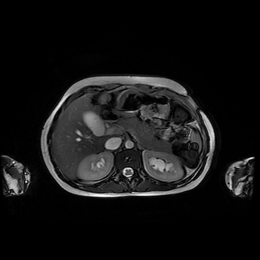 File:Normal MRI abdomen in pregnancy (Radiopaedia 88001-104541 Axial Gradient Echo 14).jpg