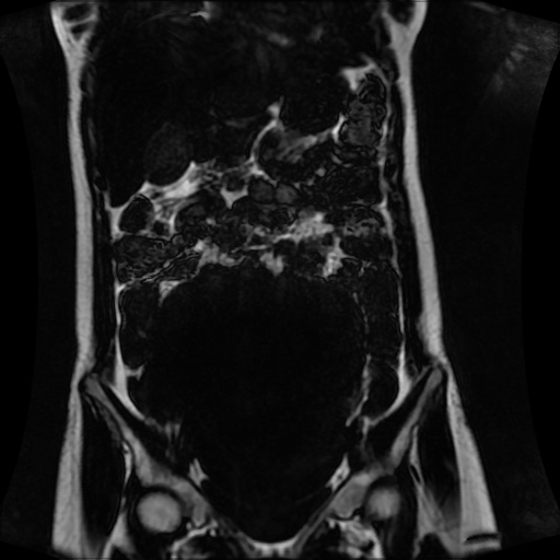 Normal MRI abdomen in pregnancy (Radiopaedia 88001-104541 N 58).jpg