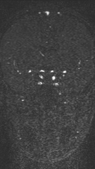Normal MRI brain with MRV- teenager (Radiopaedia 49425-54553 Coronal MRV 112).jpg