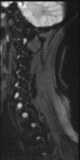 File:Normal MRI cervical spine (infection protocol) (Radiopaedia 53916-60039 Sagittal DWI 13).png