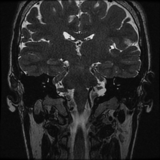 Normal MRI petrous (Radiopaedia 91317-108949 Coronal T2 60).jpg