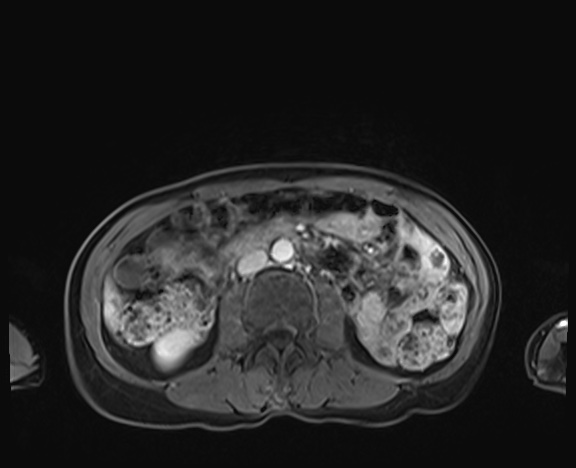 Normal adrenal glands MRI (Radiopaedia 82017-96004 K 52).jpg