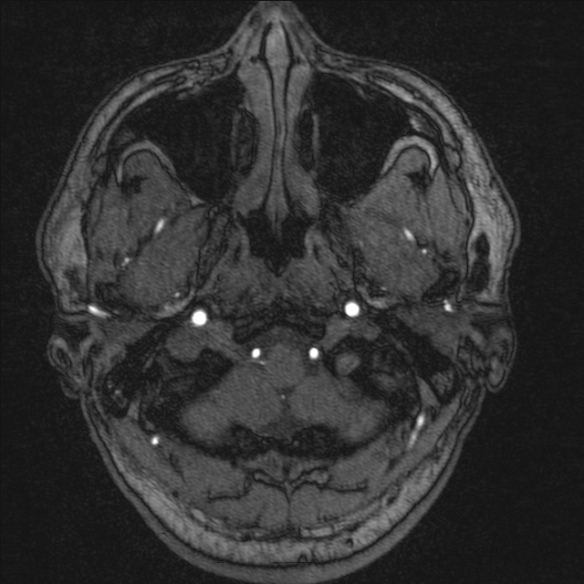 Normal brain MRI including MRA (Radiopaedia 48748-53763 Axial MRA 11).jpg