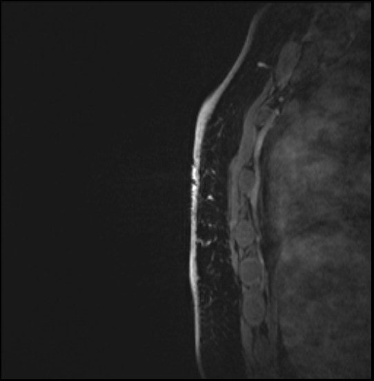 Normal breast MRI - dense breasts (Radiopaedia 80454-93850 I 162).jpg