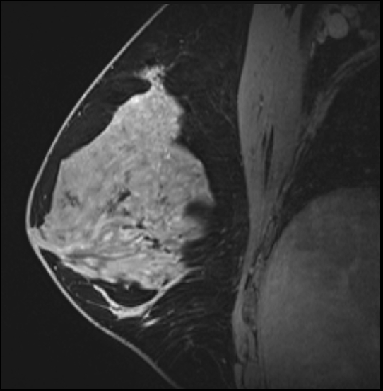 Normal breast MRI - dense breasts (Radiopaedia 80454-93850 I 88).jpg