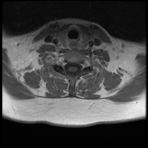 File:Normal cervical and thoracic spine MRI (Radiopaedia 35630-37156 Axial T1 C+ 11).png