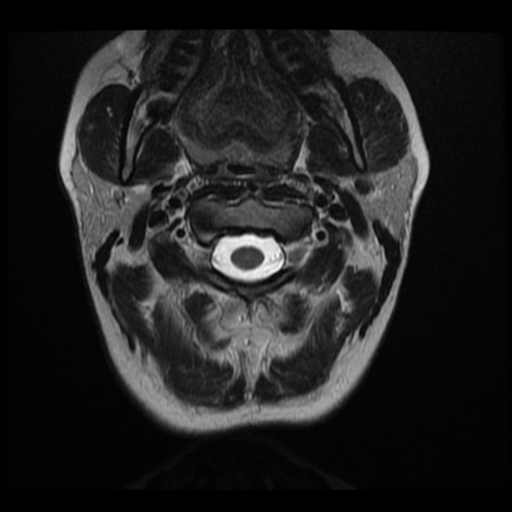 File:Normal cervical and thoracic spine MRI (Radiopaedia 35630-37156 Axial T2 29).png
