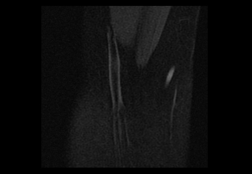 File:Normal elbow arthrograms (Radiopaedia 75550-86805 Coronal T1 fat sat 18).jpg