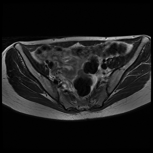 File:Normal female pelvis MRI (retroverted uterus) (Radiopaedia 61832-69933 Axial T2 13).jpg