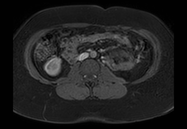 Normal liver MRI with Gadolinium (Radiopaedia 58913-66163 J 2).jpg
