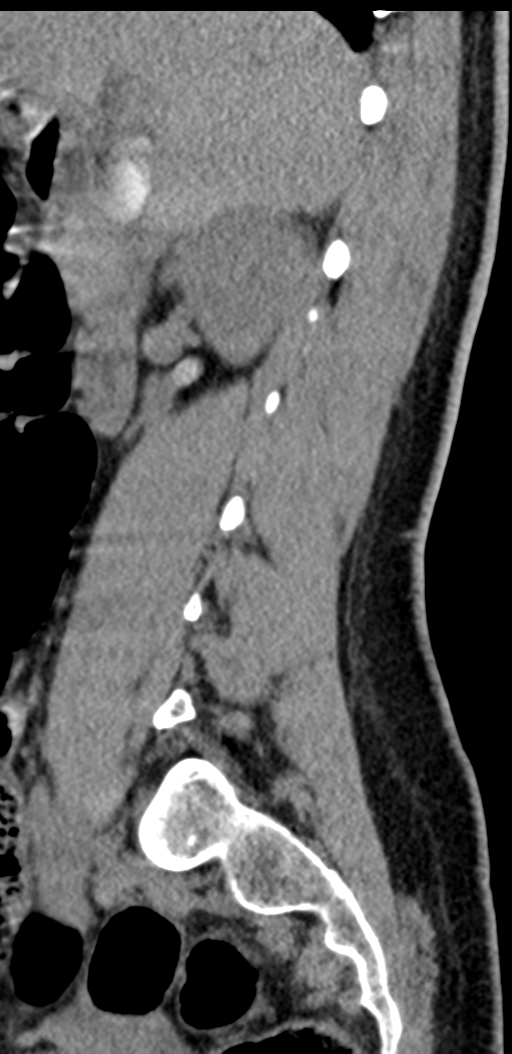 Normal lumbosacral CT (Radiopaedia 37923-39867 E 79).png