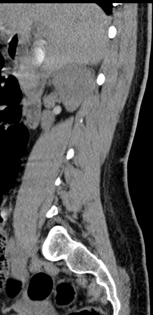 Normal lumbosacral CT (Radiopaedia 37923-39867 E 80).png