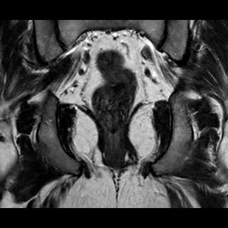 File:Normal prostate (MRI) (Radiopaedia 29986-30535 Coronal T2 18).jpg