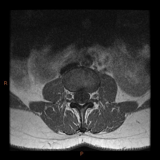 File:Normal spine MRI (Radiopaedia 77323-89408 Axial T1 6).jpg