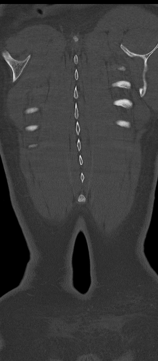 Normal thoracolumbar spine (Radiopaedia 43822-47309 Coronal bone window 86).png