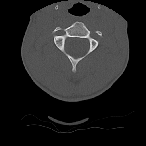 Normal trauma spine imaging (age 16) (Radiopaedia 45335-49358 Axial bone window 21).jpg