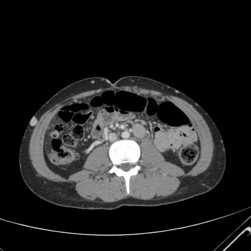File:Nutmeg liver- Budd-Chiari syndrome (Radiopaedia 46234-50635 B 37).png