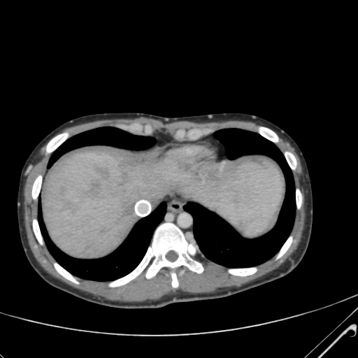 File:Nutmeg liver- Budd-Chiari syndrome (Radiopaedia 46234-50635 B 7).png
