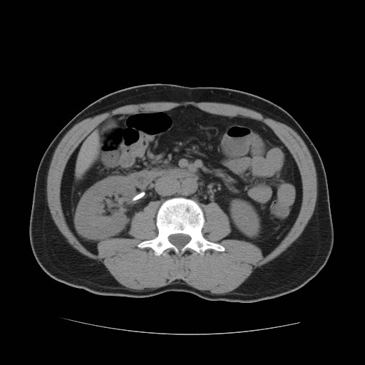File:Obstructed kidney with perinephric urinoma (Radiopaedia 26889-27067 Axial non-contrast 16).jpg