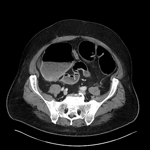 Obstructing sigmoid adenocarcinoma (Radiopaedia 58465-65619 A 121).jpg