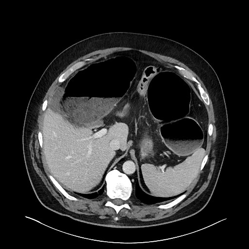 Obstructing sigmoid adenocarcinoma (Radiopaedia 58465-65619 A 39).jpg