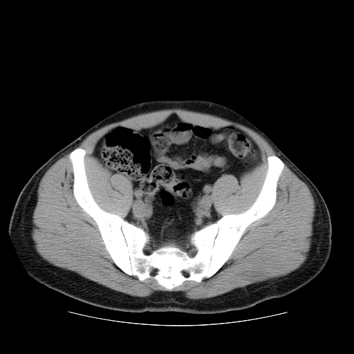 File:Obstructing ureteric calculus (Radiopaedia 18615-18514 Axial non-contrast 44).jpg