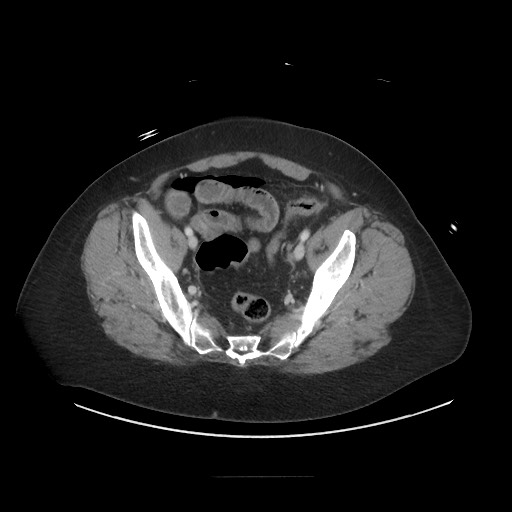 Obstructive distal colonic adenocarcinoma causing cecal perforation (Radiopaedia 86830-102989 A 161).jpg