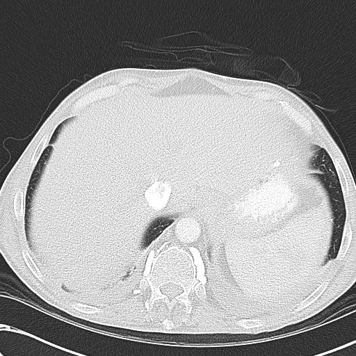File:Obstructive superior vena cava tumor thrombus (Radiopaedia 28046-28306 Axial lung window 48).jpg